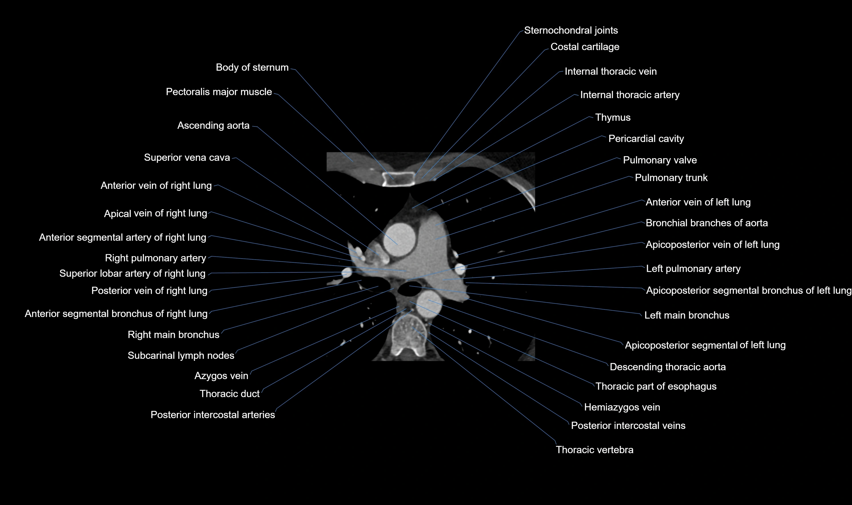 CT heart (coronary angiogram) axial view cross sectional anatomy labelled radiology image-00009.webp